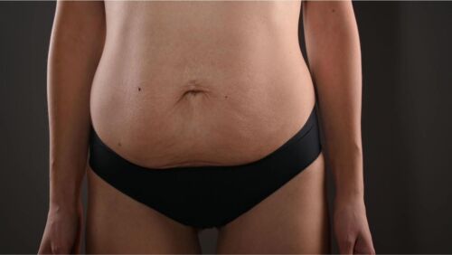 postpartum belly