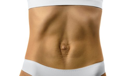 Diastasis Recti Hernia